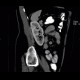 Angiomyolipoma of kidney, atypical: CT - Computed tomography